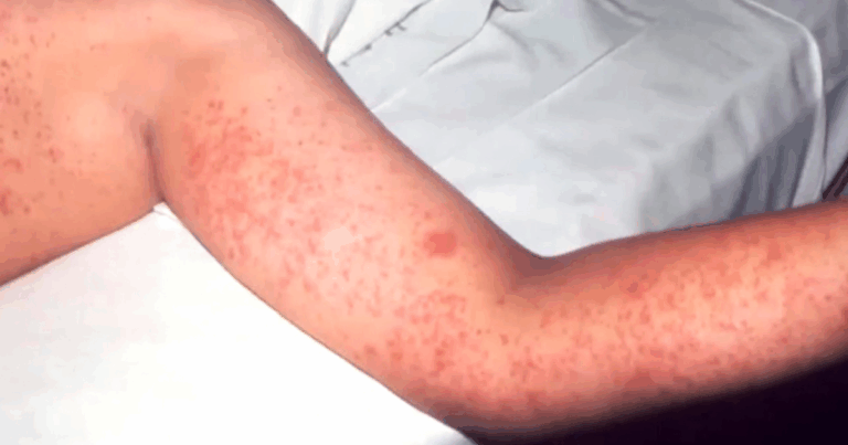 measles 0409